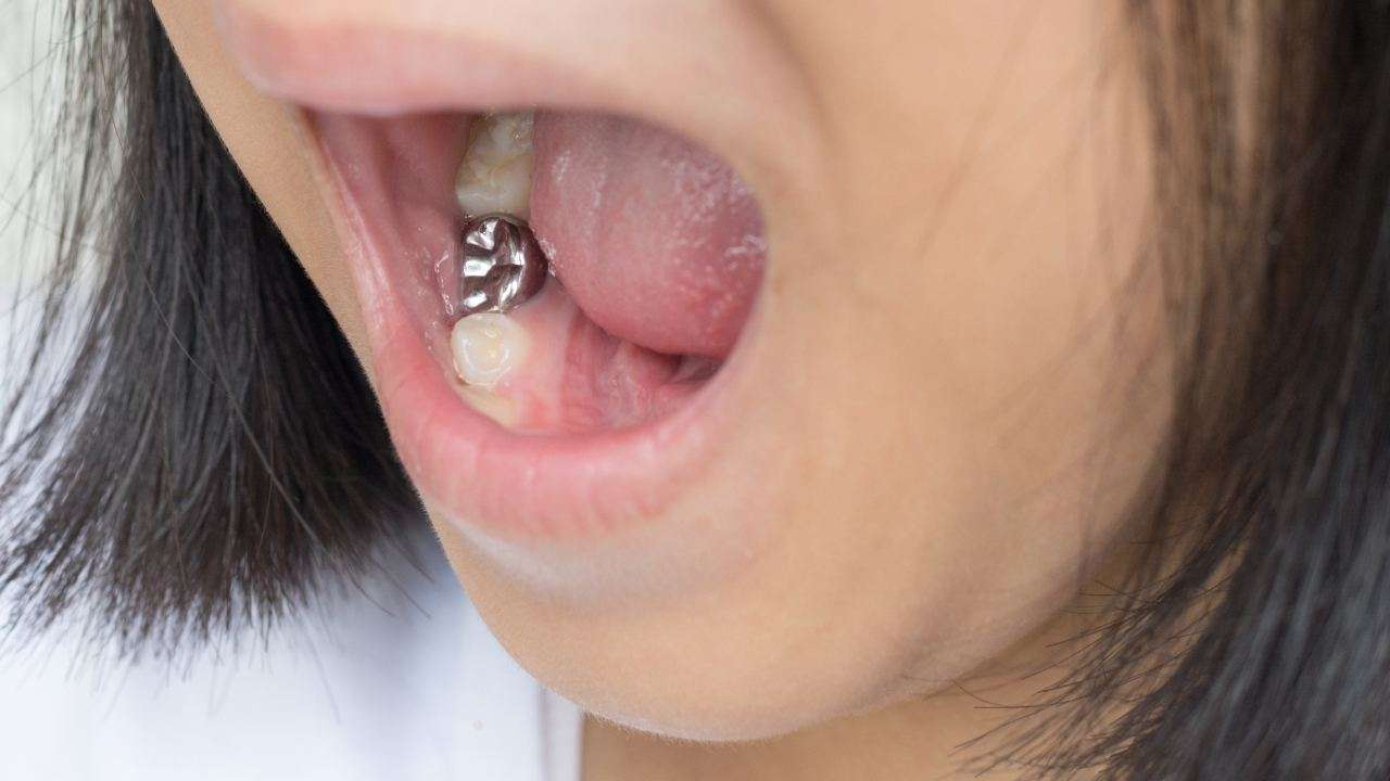 amalgama dentale effetti collaterali